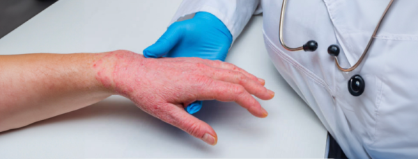 Как и чем лечить псориаз