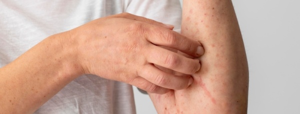 Атопический дерматит у взрослых: факторы риска