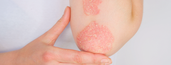 Обострился псориаз: как ухаживать за кожей