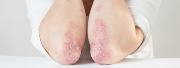 От чего появляется псориаз?