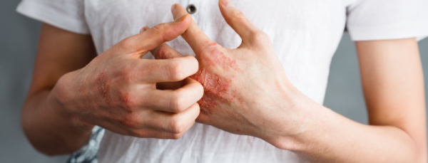 Атопический дерматит: факторы риска