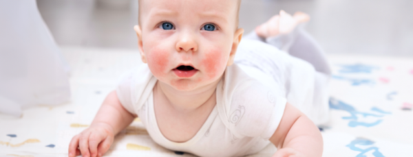 Что делать, если у ребенка атопический дерматит?